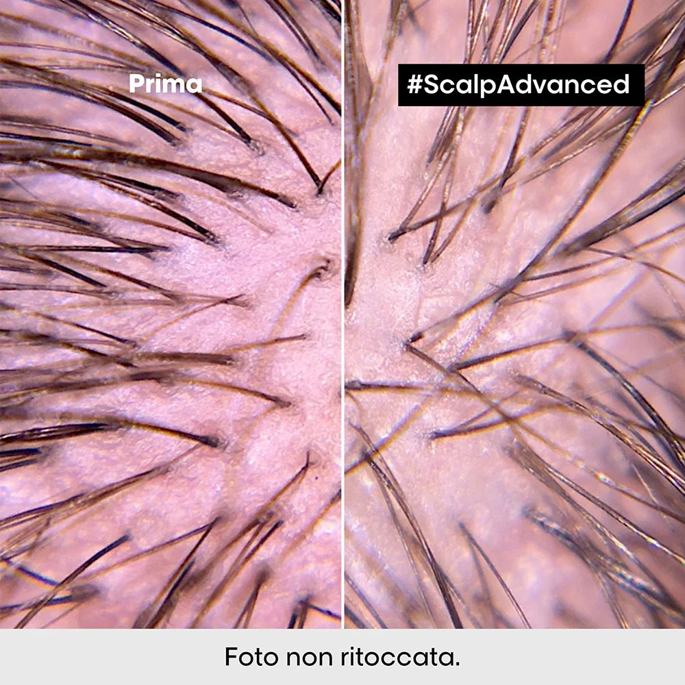L'oreal Professionnel Scalp Advanced Trattamento Intense Soother Anti-Discomfort 200 ml - Image 4